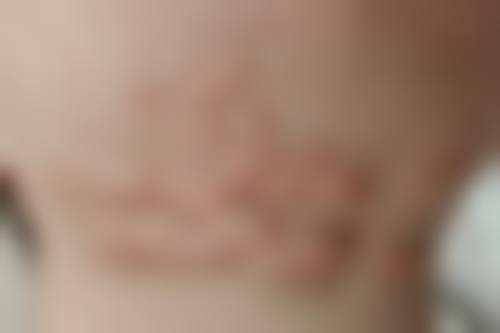 环钻去疤治疗次数