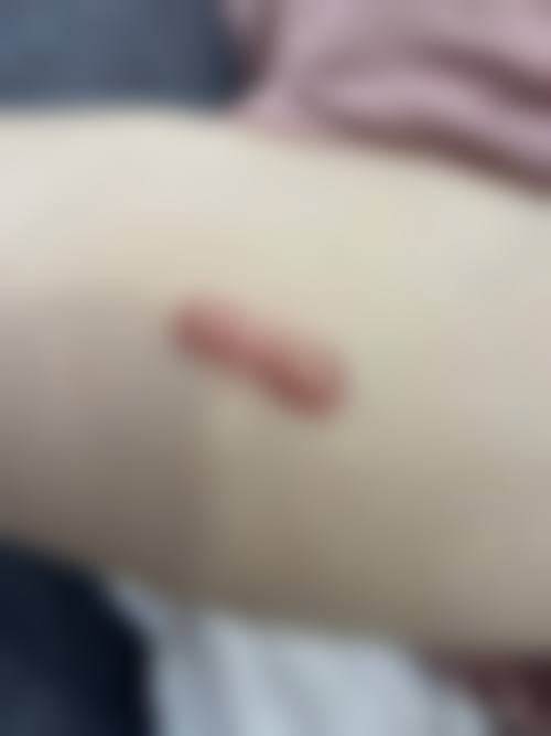 环钻去疤优势体现