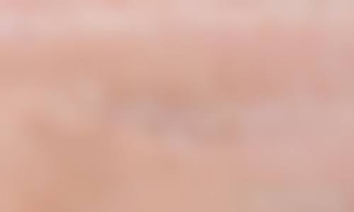 环钻去疤适用范围