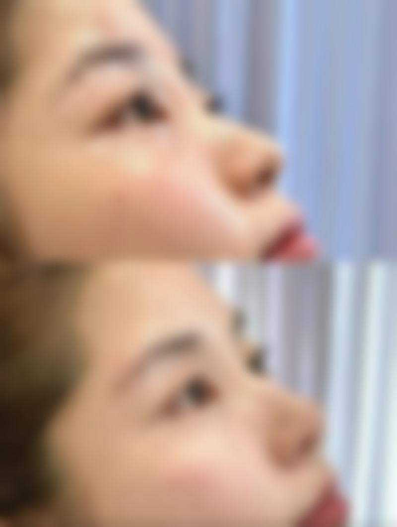 白色疤痕如何淡化？试试药物、激光和自然疗法，坚持护理可显著改善！ 