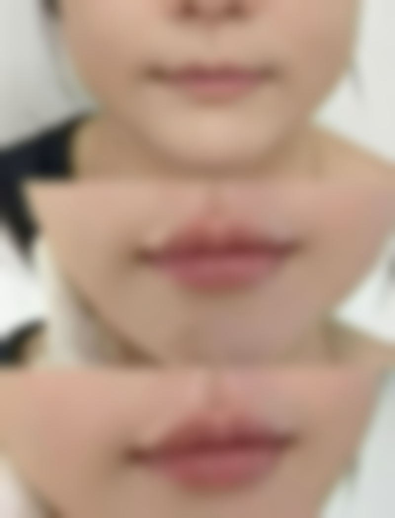 天然食材：巧用食材助力疤痕修复