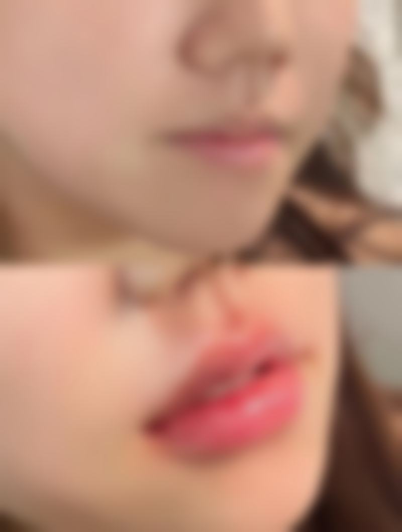 3D生物束带缩阴术：持久修复的理想之选