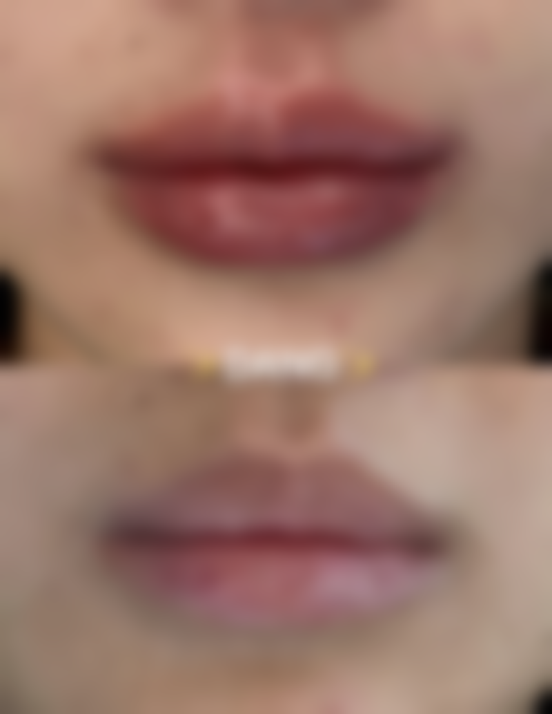 术后护理：悉心呵护促进疤痕修复