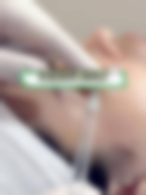 李广学和任冲谁做川字纹更好？李广学填充恢复快，任冲手术长效，口碑都不错！