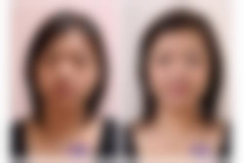 治疗后的注意事项:促进疤痕修复