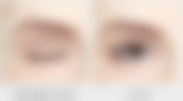 术后注意事项：悉心护理促进修复