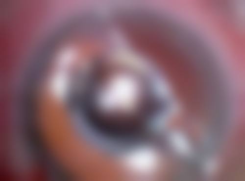 疤痕增生很厚怎么办？别慌，可先就医定方案，SRT100浅放或巴克疗法改善效果显著！ 