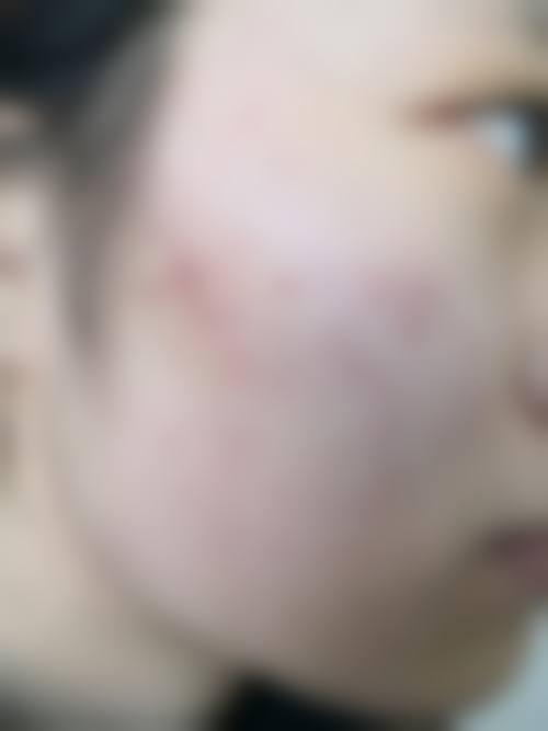 为什么医生不建议针清｜易致皮肤受损感染留疤，正规医院有更优祛痘方案