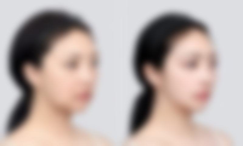 美国麦格：高品质记忆型隆胸假体典范