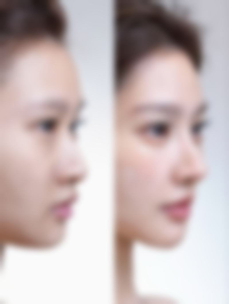 一起抽脂的修复情况与注意事项