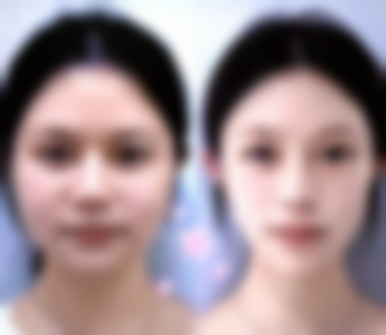 环钻治疗：灵活应对疤痕的“多面手”