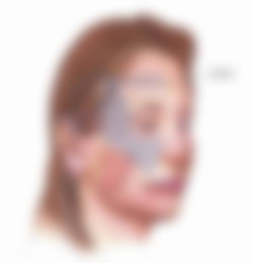 点痣后疤痕增生的预防与护理