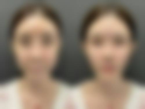 睡觉与双眼皮修复成效的关系