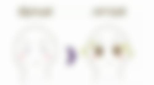 混合纹综合治疗——光电项目与填充结合