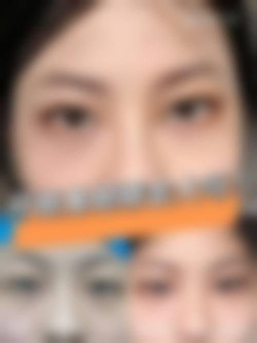 双眼皮手术价格解析