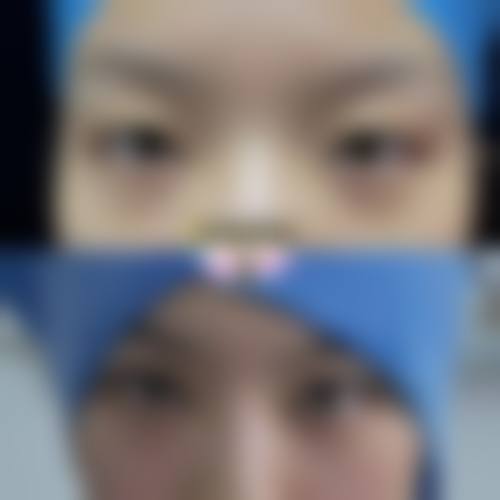 青岛博士整形双眼皮谁做的好一点？陈昇广、王建宇医生技术精湛，反馈佳电话 838 xxx ！ 