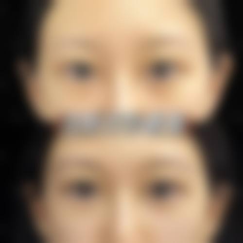 郑州第一附属医院割双眼皮价格公布：埋线2800 - 4800元、全切3800 - 7500元，价格透明可参考！ 