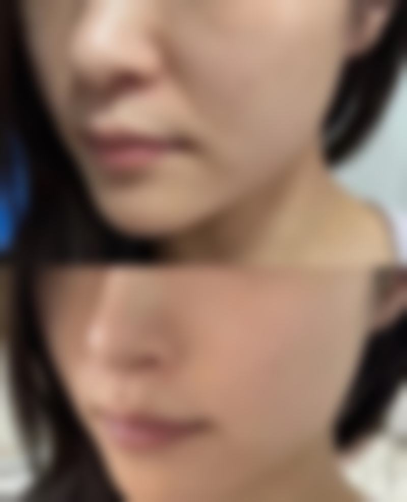 使用疤痕贴淡化色素的正确姿势