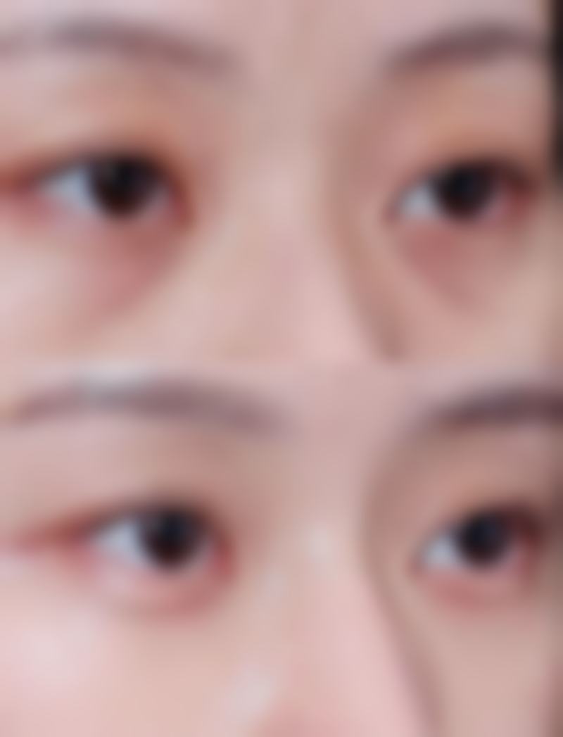 疤痕贴可以淡化疤痕色素吗？能！它靠保湿和药物成分，对新生疤痕效果显著，持续用3 - 6个月可见效 