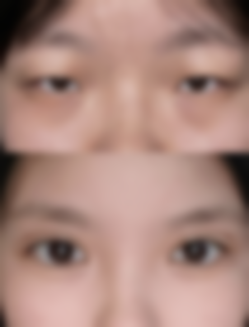 使用疤痕贴淡化色素的注意事项