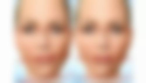 冷敷热敷交替用，快速缓解眼袋肿