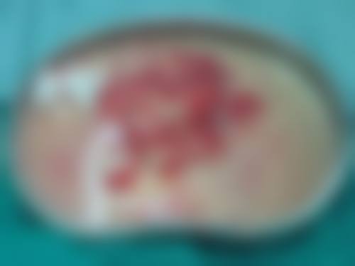 2026广州海峡取奥美定正规吗？谭新东医师经验足技术好，口碑佳案例多超靠谱！ 