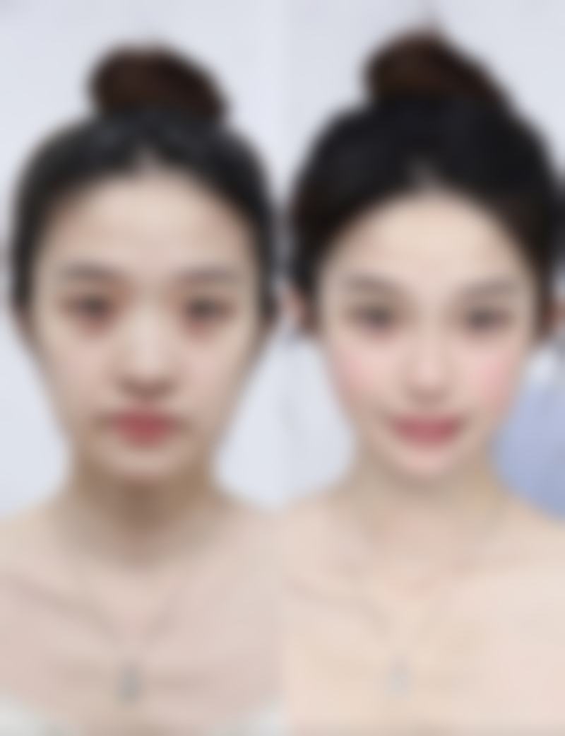 如何选择适合自己的疤痕增生治疗方法