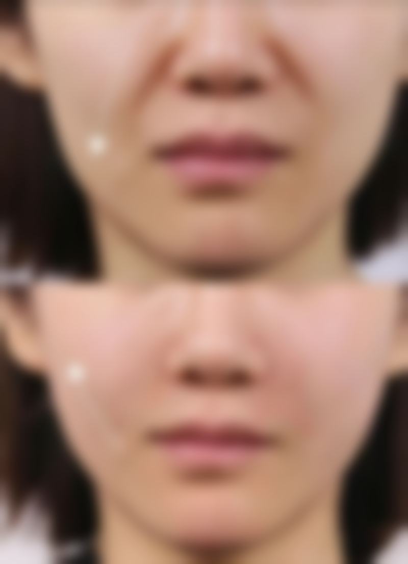 割双眼皮能吃什么水果更好？苹果、蓝莓、猕猴桃等就很不错，能促进伤口愈合、减轻炎症！ 