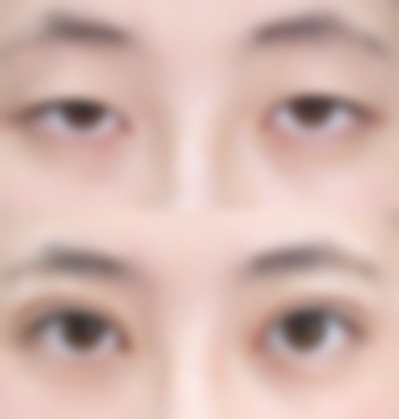 割双眼皮后的注意事项有哪些？记住这些，伤口愈合快还不留疤！如保持清洁、忌辛辣和剧烈运动