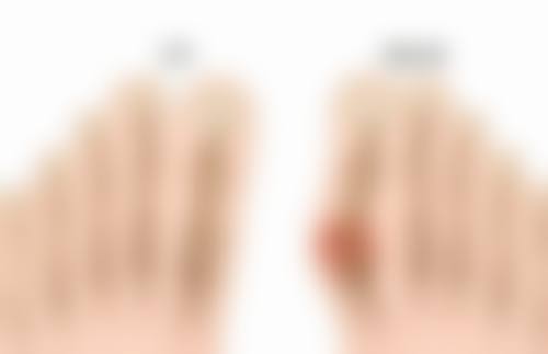 全切双眼皮开刀的价格及影响因素