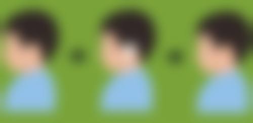 运动对割双眼皮修复的影响