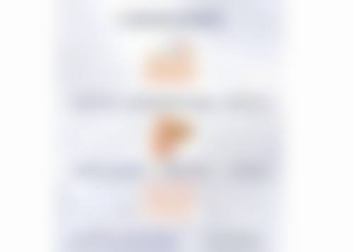 埋线法：创伤小修复快的双眼皮手术