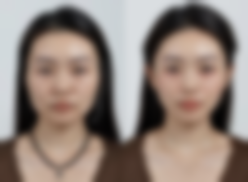 割双眼皮后年龄增长，眼部护理不可忽视