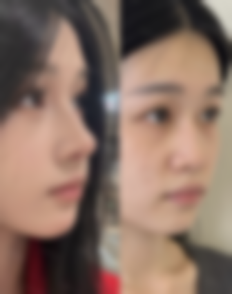 如何才能消掉疤痕体质？巧用激光治疗+药物涂抹，双管齐下有效改善疤痕体质！ 