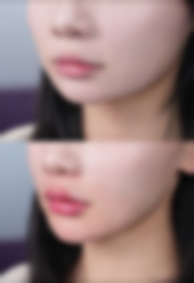 选择专精医生，保护割双眼皮后长期成效