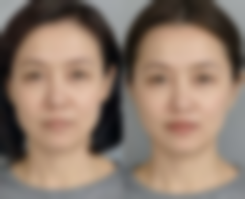 河南省人民医院激光价格表最新：近视、白内障、青光眼手术价格透明，口碑佳值得信赖！ 