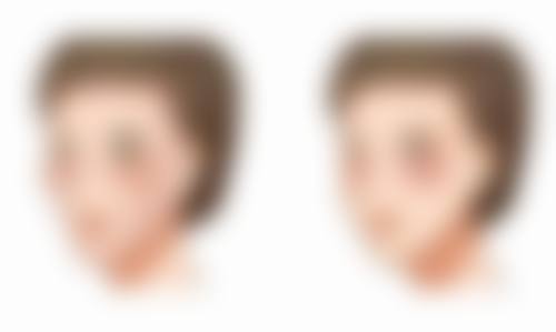 费用详情：抽脂手术收费及影响因素