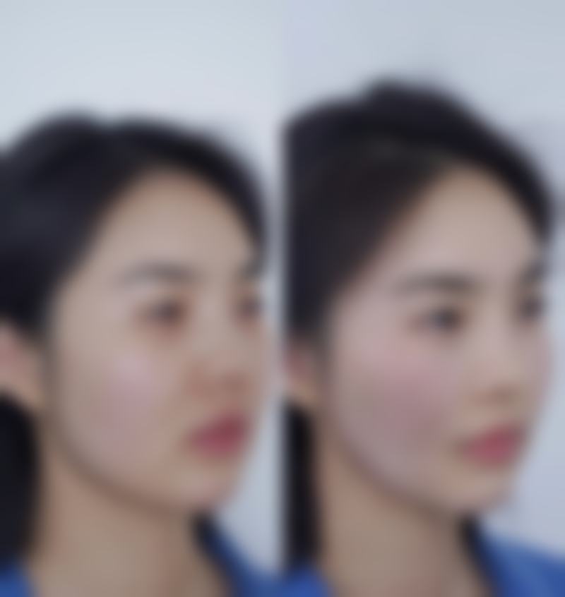 解读：两大医院臀部抽脂的合理收费价格