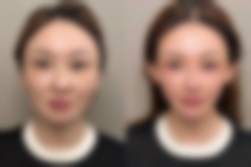 见证：两大医院臀部抽脂的显著手术成效