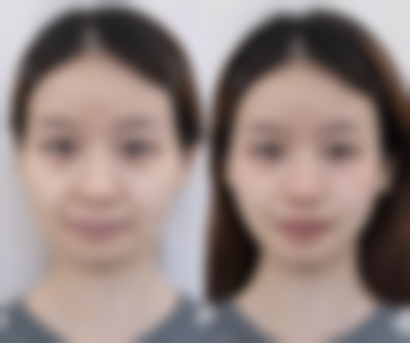 手术成效有保护