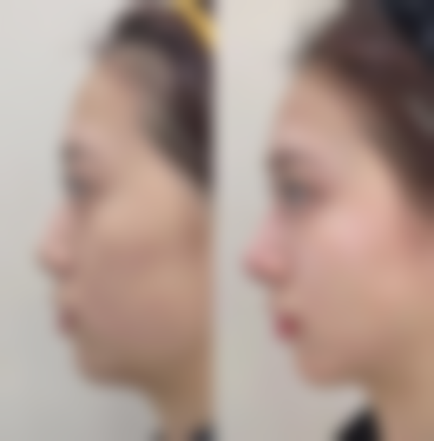 抽脂手术有危险吗？有！但[医院具体名称]正规资质+先进技术，多案例见证安全塑身！ 