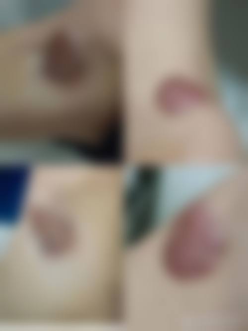 多类疤痕能修复