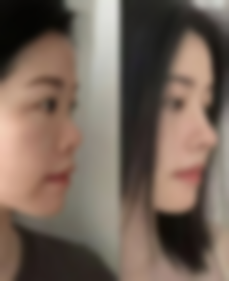 高新科技来袭!医美手段助力产后疤痕快速修复