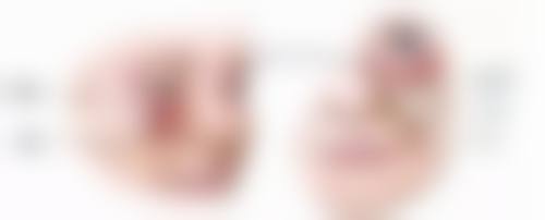 压力治疗：持续施压，让疤痕变平变软