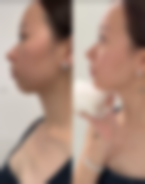 手术治疗：切除疤痕组织，重获理想肌肤