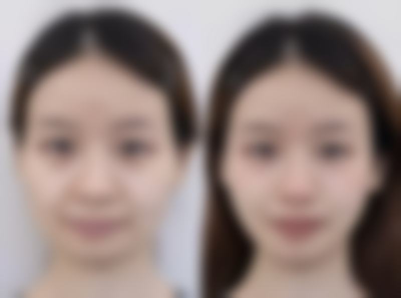 切开法：复杂多层双眼皮的有效解决方案