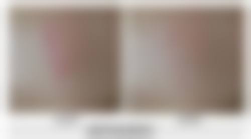 专精去眼袋：[XX市第一人民医院]的优势