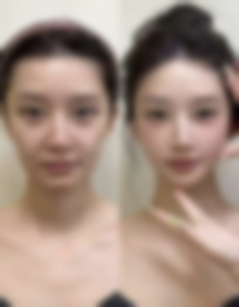 去眼袋手术：成效与体验