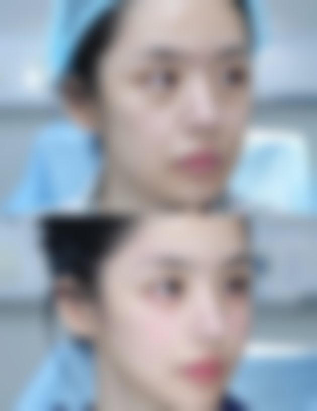 双侧乳房不对称：手术精细度的挑战