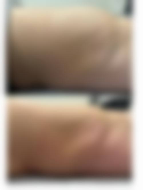 厦门哪里医院可以治疗富贵包？厦门海峡、薇格等医院，设备先进技术好，口碑佳！ 